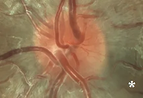 Series of optic disc photographs showing progressive changes in a patient with Leber hereditary optic neuropathy from presymptomatic stage to chronic optic atrophy.