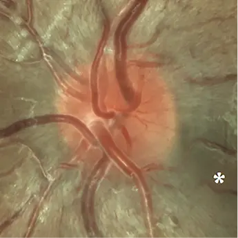 Series of optic disc photographs showing progressive changes in a patient with Leber hereditary optic neuropathy from presymptomatic stage to chronic optic atrophy.
