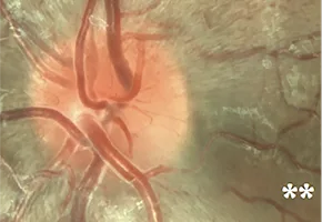 Series of optic disc photographs showing progressive changes in a patient with Leber hereditary optic neuropathy from presymptomatic stage to chronic optic atrophy.