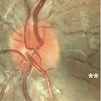 Series of optic disc photographs showing progressive changes in a patient with Leber hereditary optic neuropathy from presymptomatic stage to chronic optic atrophy.