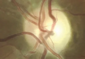 Series of optic disc photographs showing progressive changes in a patient with Leber hereditary optic neuropathy from presymptomatic stage to chronic optic atrophy.