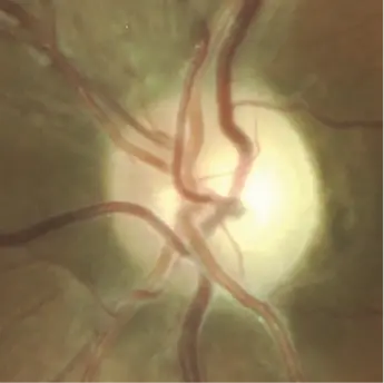 Series of optic disc photographs showing progressive changes in a patient with Leber hereditary optic neuropathy from presymptomatic stage to chronic optic atrophy.