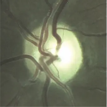 Series of optic disc photographs showing progressive changes in a patient with Leber hereditary optic neuropathy from presymptomatic stage to chronic optic atrophy.